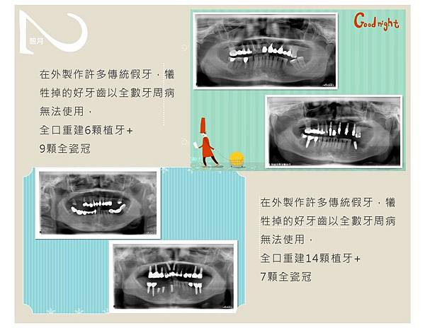 全口重建案例-4.jpg