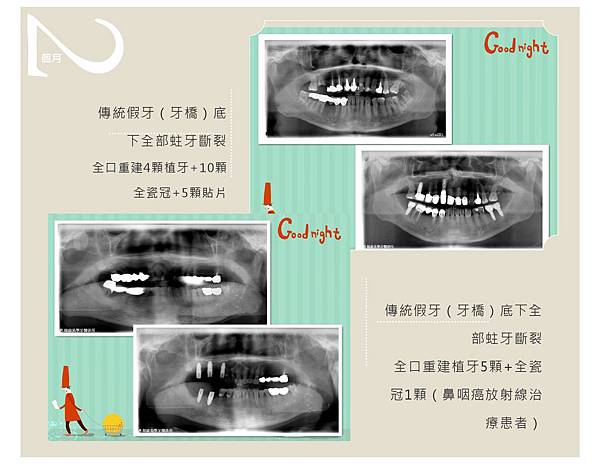 全口重建案例-6.jpg