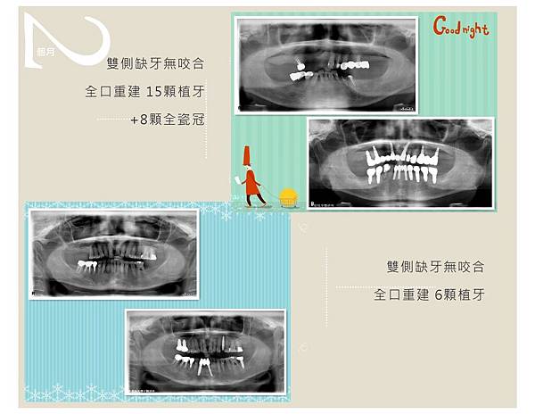 全口重建案例-8.jpg