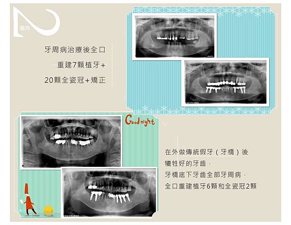全口重建案例-7.jpg