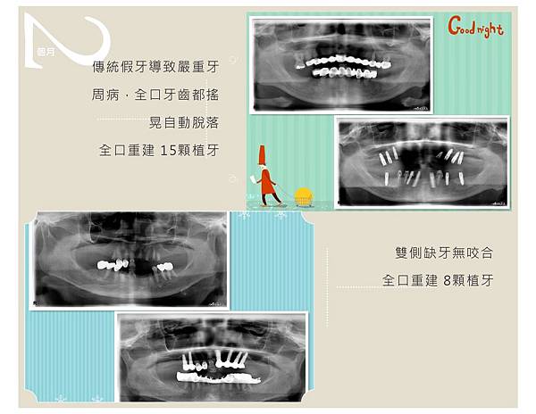 全口重建案例-10.jpg