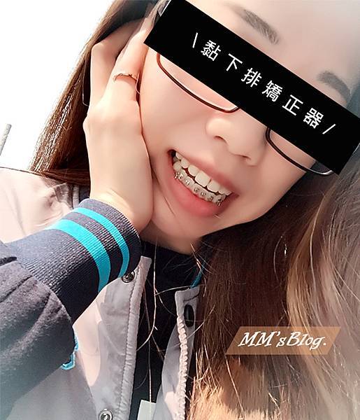 黏下排矯正器 黏下排矯正器