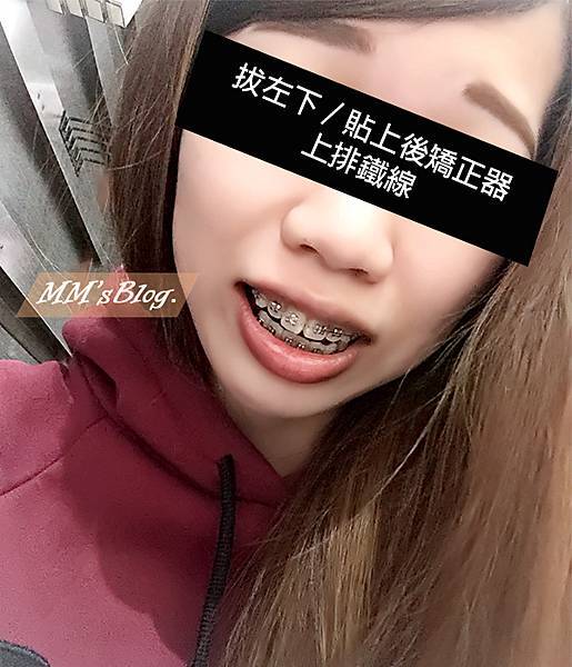 捕牙套 捕牙套