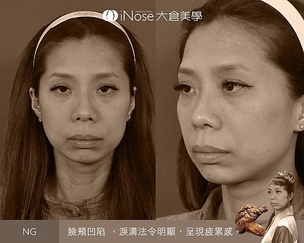隆鼻玻尿酸 (3).jpg 隆鼻玻尿酸 (3).jpg