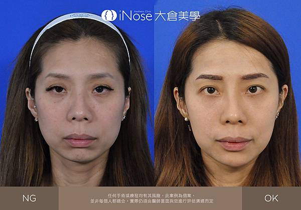 隆鼻玻尿酸 (5).jpg 隆鼻玻尿酸 (5).jpg