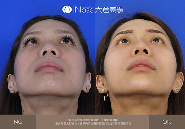 隆鼻玻尿酸 (6).jpg 隆鼻玻尿酸 (6).jpg