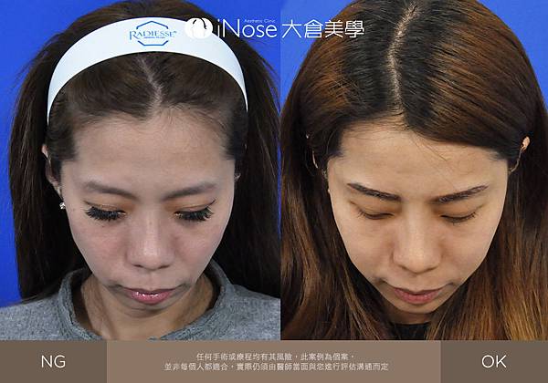 隆鼻玻尿酸 (7).jpg 隆鼻玻尿酸 (7).jpg