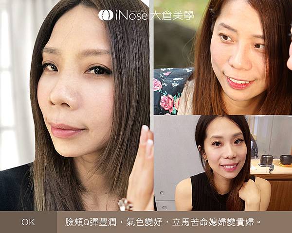 隆鼻玻尿酸 (10).jpg 隆鼻玻尿酸 (10).jpg