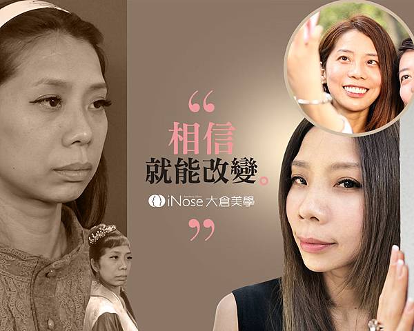 隆鼻玻尿酸 (11).jpg 隆鼻玻尿酸 (11).jpg