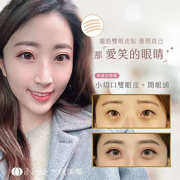 台北雙眼皮 開眼頭 開眼尾 韓式雙眼皮 日式雙眼皮 小切口雙眼皮 定書針 縫雙眼皮 割雙眼皮 保留血管網 雙眼皮案例 雙眼皮價格 雙眼皮推薦_01.jpg 台北雙眼皮 開眼頭 開眼尾 韓式雙眼皮 日式雙眼皮 小切口雙眼皮 定書針 縫雙眼皮 割雙眼皮 保留血管網 雙眼皮案例 雙眼皮價格 雙眼皮推薦_01.jpg