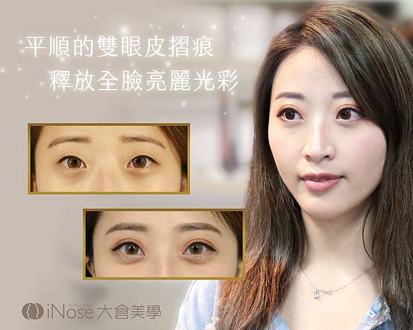 台北雙眼皮 開眼頭 開眼尾 韓式雙眼皮 日式雙眼皮 小切口雙眼皮 定書針 縫雙眼皮 割雙眼皮 保留血管網 雙眼皮案例 雙眼皮價格 雙眼皮推薦_02 (5).jpg 台北雙眼皮 開眼頭 開眼尾 韓式雙眼皮 日式雙眼皮 小切口雙眼皮 定書針 縫雙眼皮 割雙眼皮 保留血管網 雙眼皮案例 雙眼皮價格 雙眼皮推薦_02 (5).jpg