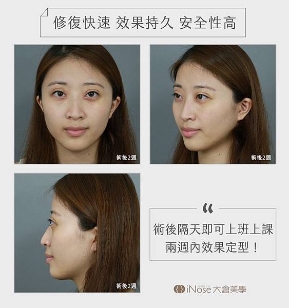 台北雙眼皮 開眼頭 開眼尾 韓式雙眼皮 日式雙眼皮 小切口雙眼皮 定書針 縫雙眼皮 割雙眼皮 保留血管網 雙眼皮案例 雙眼皮價格 雙眼皮推薦_02 (4).jpg 台北雙眼皮 開眼頭 開眼尾 韓式雙眼皮 日式雙眼皮 小切口雙眼皮 定書針 縫雙眼皮 割雙眼皮 保留血管網 雙眼皮案例 雙眼皮價格 雙眼皮推薦_02 (4).jpg