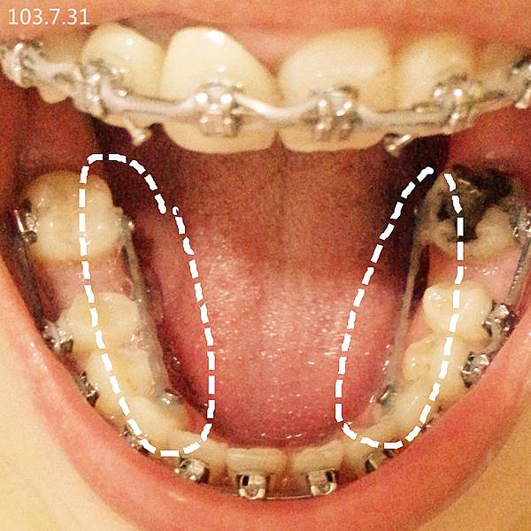 矯正器與我 下排牙齒內縮加強1030731 Chibella 痞客邦