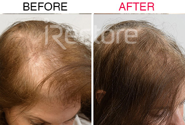 53歲女性(使用5個月)