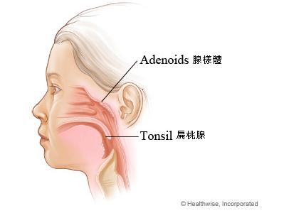 Adenoids&Tonsils.bmp Adenoids&Tonsils.bmp