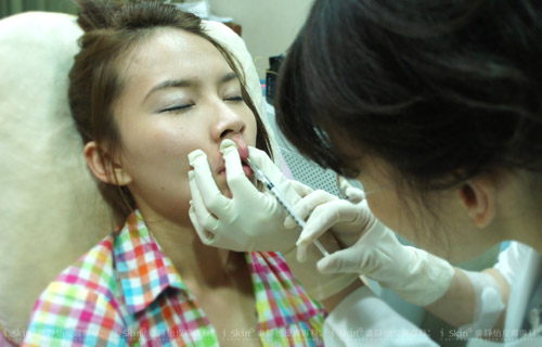 玻尿酸豐唇注射開始～打造性感唇珠並雕塑唇型