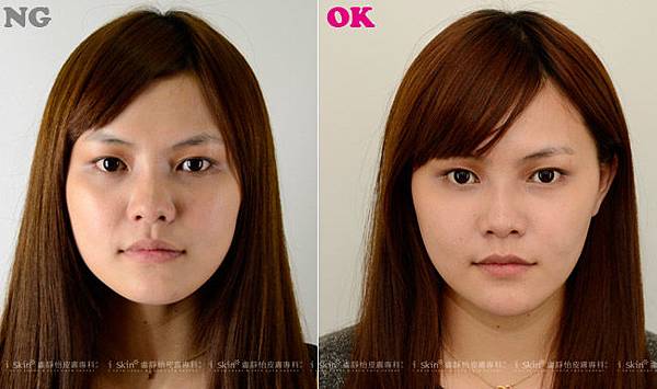 玻尿酸肉毒瘦小臉06