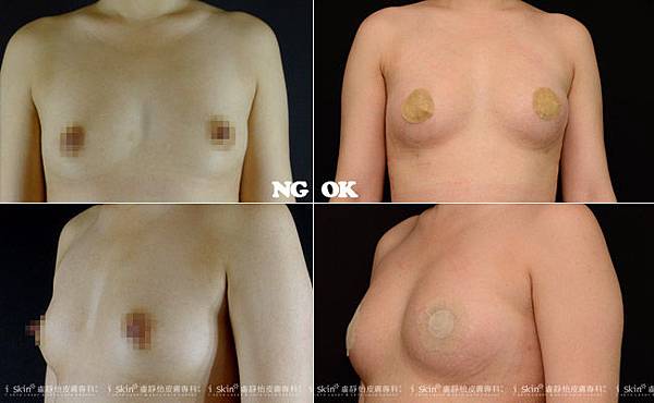 自體脂肪豐胸02