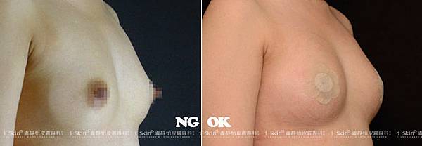 自體脂肪豐胸03