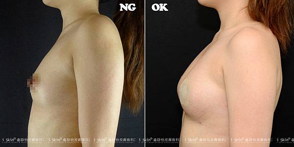 自體脂肪豐胸08
