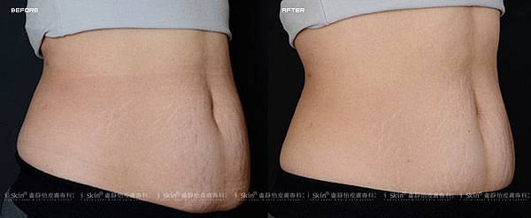 輕脂電波術前術後