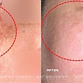 日式美姬淨膚案例01