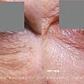 日式美姬淨膚案例04