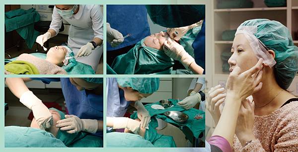 Peng Hua Ulta V-lifting2