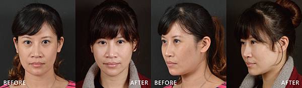 Peng Hua Ulta V-liftingba