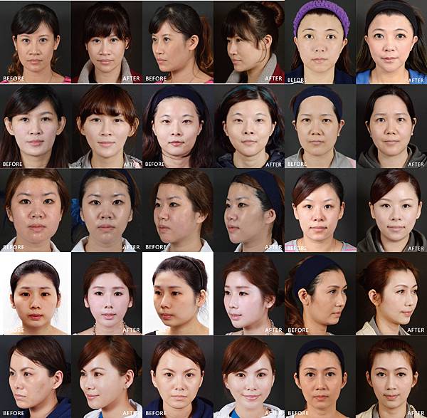 Ulta V-lifting-Other