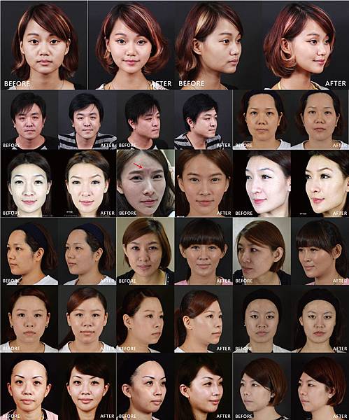 【玻尿+肉毒】小周迅尬上黑眼圈,一招擊退尷尬圓仔臉 【玻尿+肉毒】小周迅尬上黑眼圈,一招擊退尷尬圓仔臉