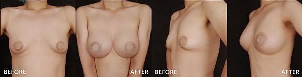 Breast augmentation-wen-ba