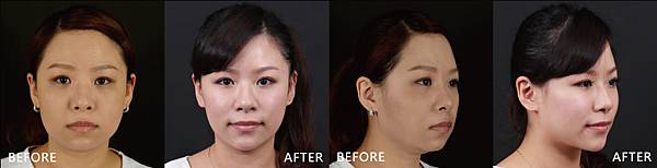 4D+Radio+Hyaluronic-Yishan-ba