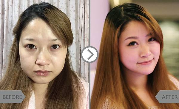 Hyaluronic+Botox-NAOMI-2 Hyaluronic+Botox-NAOMI-2