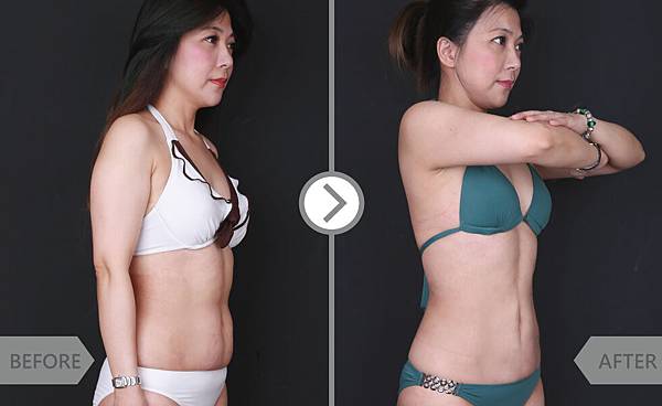 Coolsculpting-lily-2 Coolsculpting-lily-2