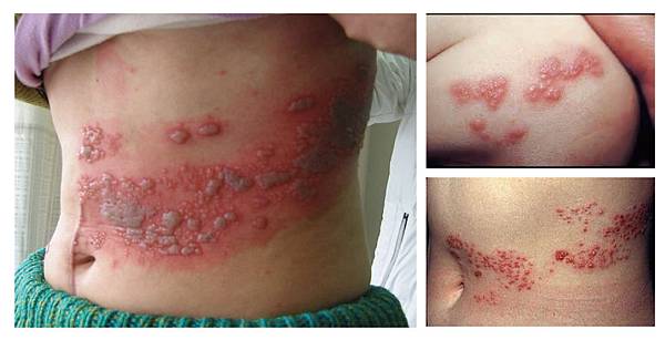 Lu-Doctor-Herpes-2 Lu-Doctor-Herpes-2