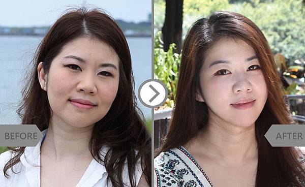 V-LOC+Hyaluronic-Ying-2 V-LOC+Hyaluronic-Ying-2