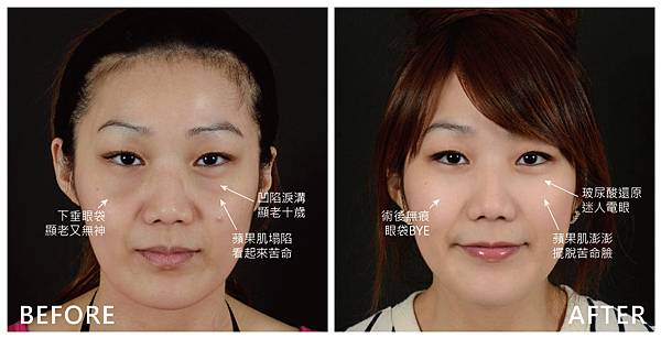 Blepharoplasty+Hyaluronic-sea-3--1