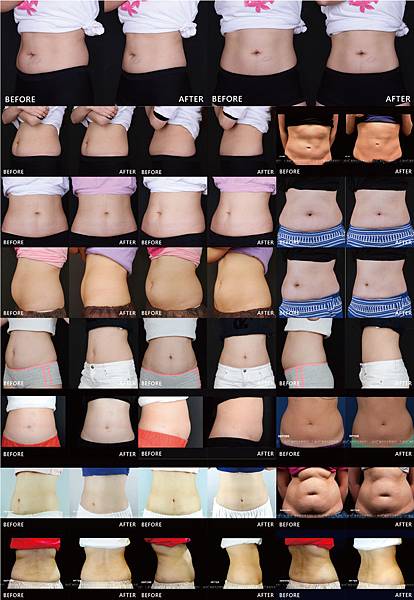 Coolsculpting-Other
