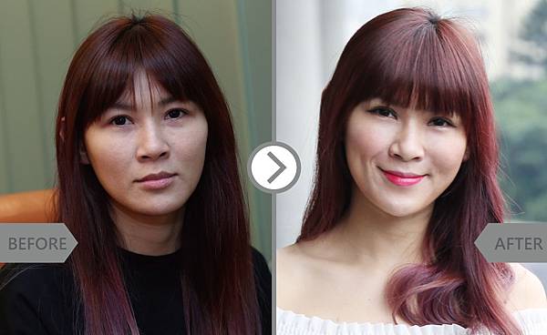 Hyaluronic+Botox-yao-2 Hyaluronic+Botox-yao-2