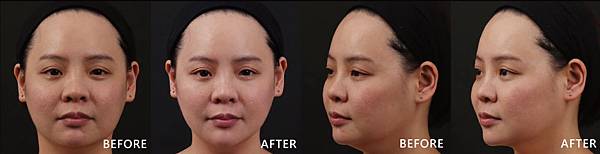 Hyaluronic+CoolSculpting-Vanessa-F-ba Hyaluronic+CoolSculpting-Vanessa-F-ba