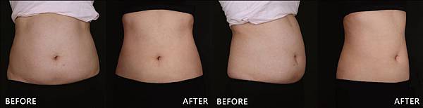 Hyaluronic+CoolSculpting-Vanessa-B-ba Hyaluronic+CoolSculpting-Vanessa-B-ba