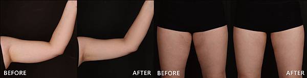 Hyaluronic+CoolSculpting-Vanessa-B1-ba Hyaluronic+CoolSculpting-Vanessa-B1-ba