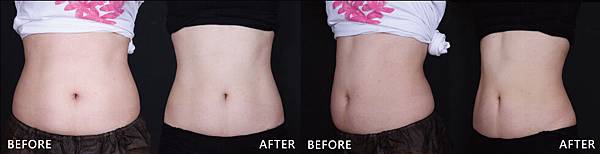 CoolSculpting-Tina-B-ba