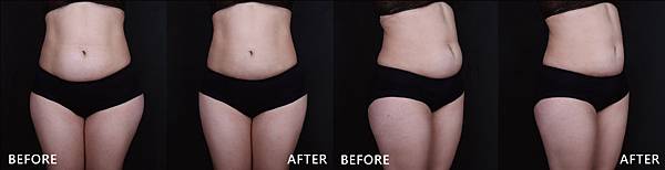 CoolSculpting-Alice-ba