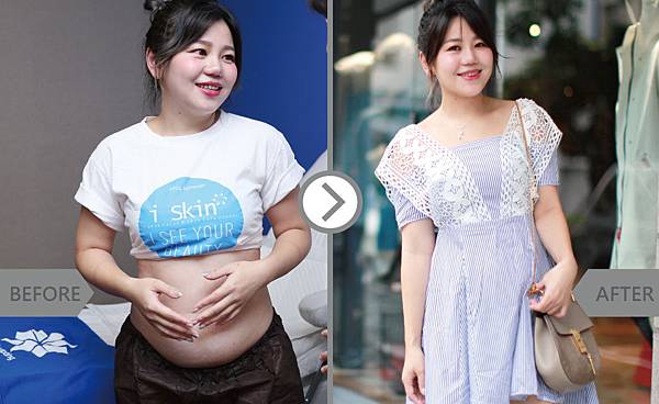 CoolSculpting-Alice-2 CoolSculpting-Alice-2