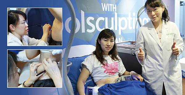 CoolSculpting-Tina-3