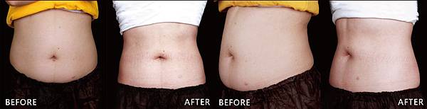 CoolSculpting-ManMan-ba