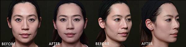 Hyaluronic+Botox-Vera-ba Hyaluronic+Botox-Vera-ba