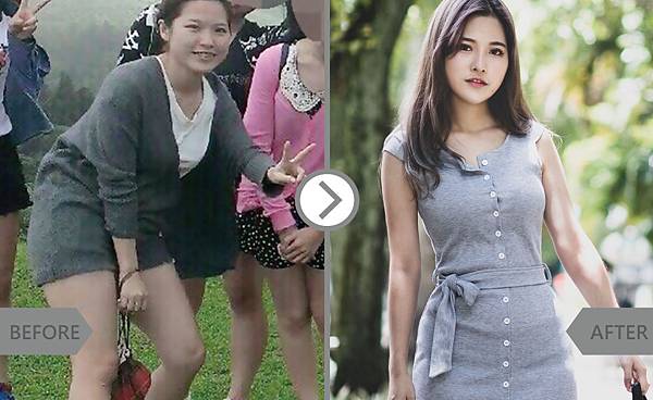 CoolSculpting-Yushan-2 CoolSculpting-Yushan-2